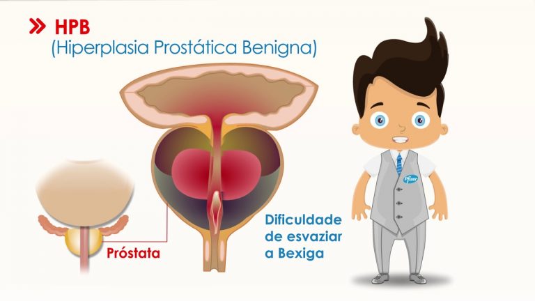 Hiperplasia Prostática Benigna Clínica De Urologia Dr Alexandre Aranha 